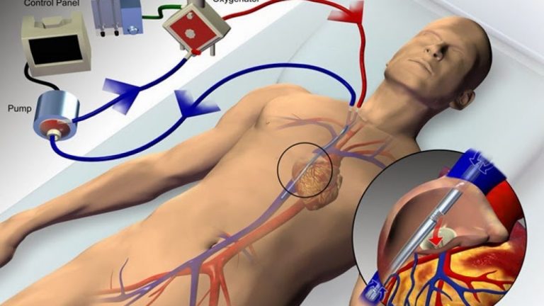 Oxigenação por membrana extracorpórea (REPRISE)