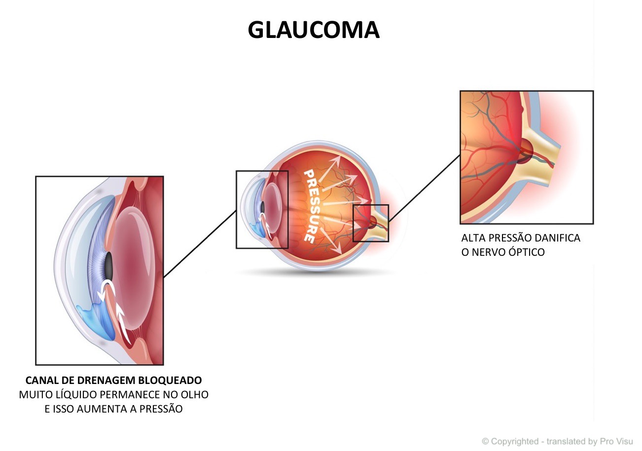 Diagnóstico do glaucoma