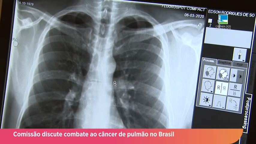 Comissão discute combate ao câncer de pulmão no Brasil