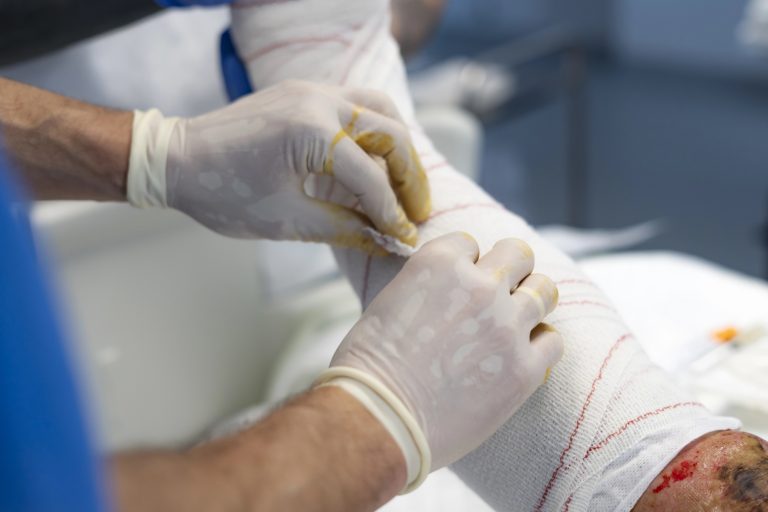 Profissional de saúde, usando luvas, faz um curativo em uma perna envolvida por faixa de gaze. Na parte inferior da imagem, o pé apresenta uma lesão extensa, com áreas avermelhadas e escurecidas. Ao fundo, desfocado, aparece parte do ambiente de atendimento médico.
